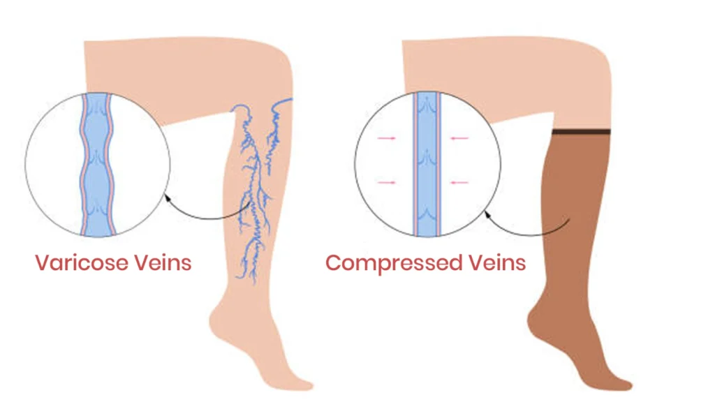 Understanding and Managing Varicose Veins