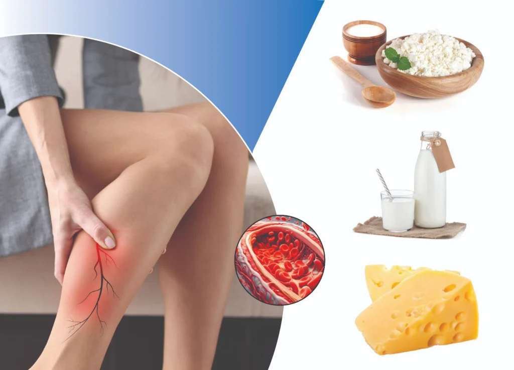 Understanding and Managing Varicose Veins