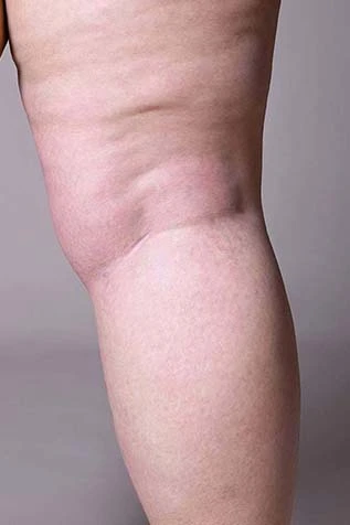 Varicose Veins