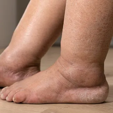 Lymphedema