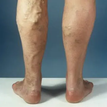 Varicose Veins